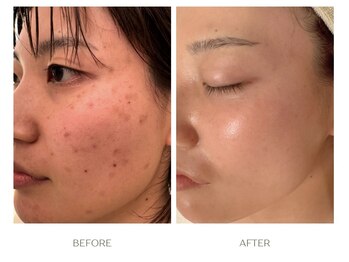 レーザー後に悪化したシミの改善例